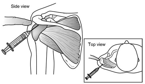 Steroid injection shoulder impingement